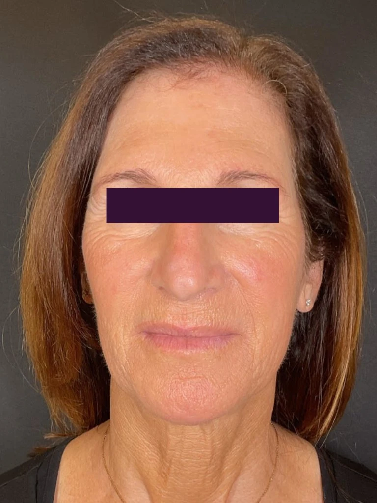 Facial Fillers - Case 5937 - After