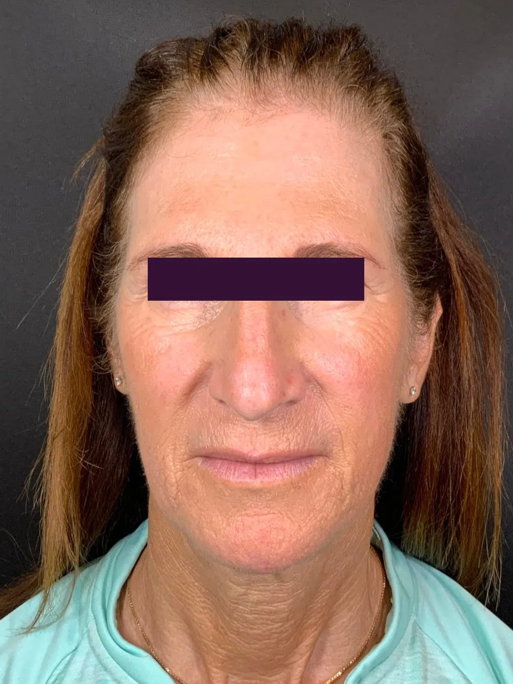 Facial Fillers Patient Photo - Case 5937 - before view-