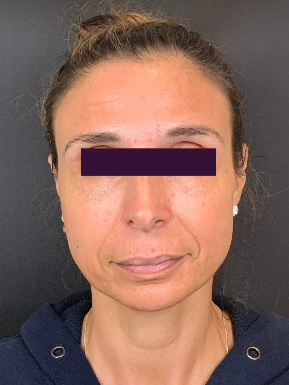 Dysport Cosmetic Patient Photo - Case 5941 - before view-