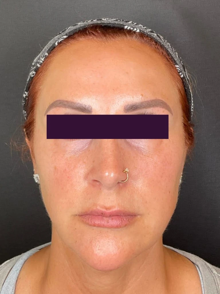 Dysport Cosmetic - Case 5951 - After