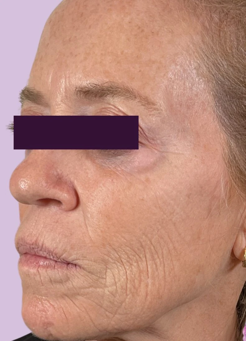 CO2 Laser Patient Photo - Case 5985 - before view-