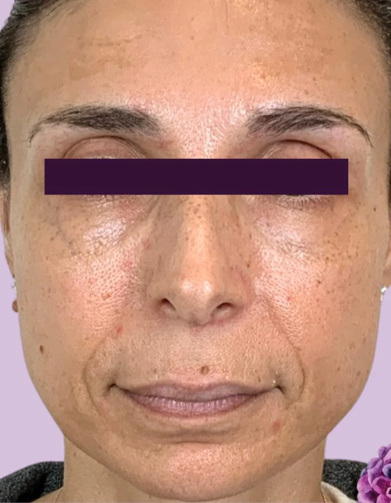 BOTOX® Cosmetic - Case 5993 - Before