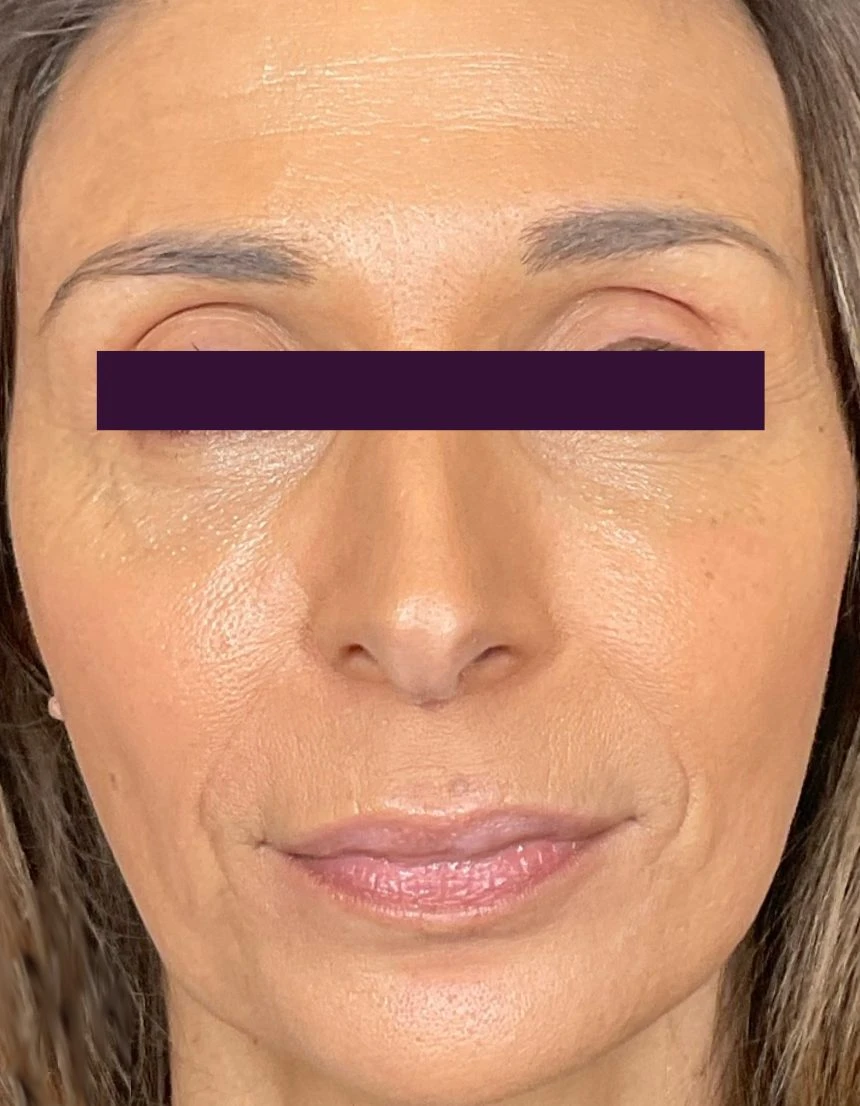 BOTOX® Cosmetic Patient Photo - Case 5993 - after view