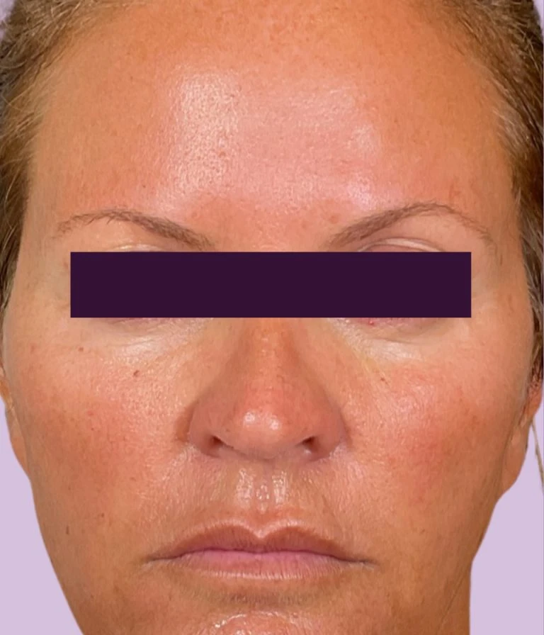 BOTOX® Cosmetic - Case 5997 - After