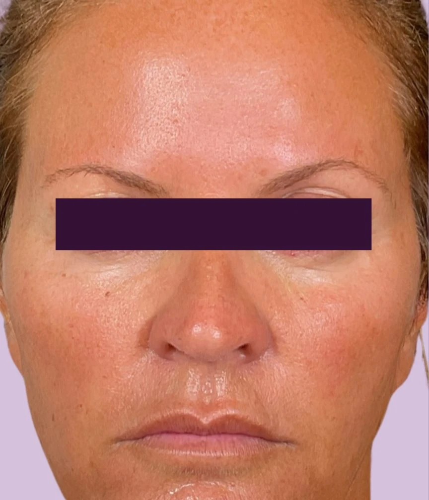 BOTOX® Cosmetic Patient Photo - Case 5997 - after view