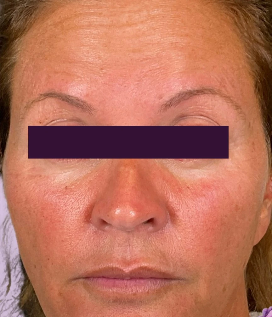 BOTOX® Cosmetic Patient Photo - Case 5997 - before view-