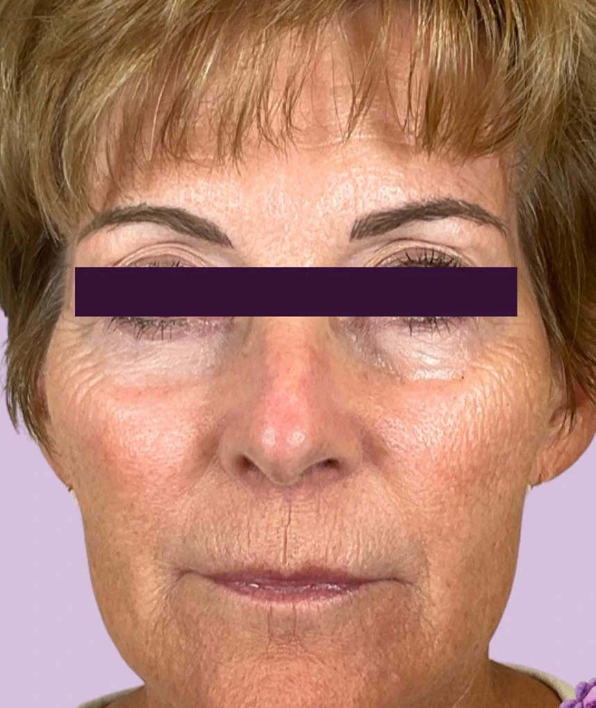 Renuva Patient Photo - Case 6001 - before view-