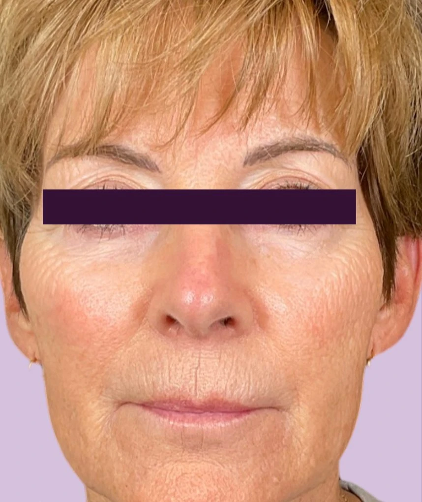 Renuva Patient Photo - Case 6001 - after view
