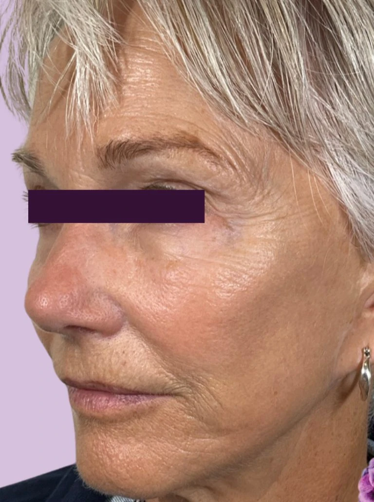 BBL /IPL - Case 6009 - Before