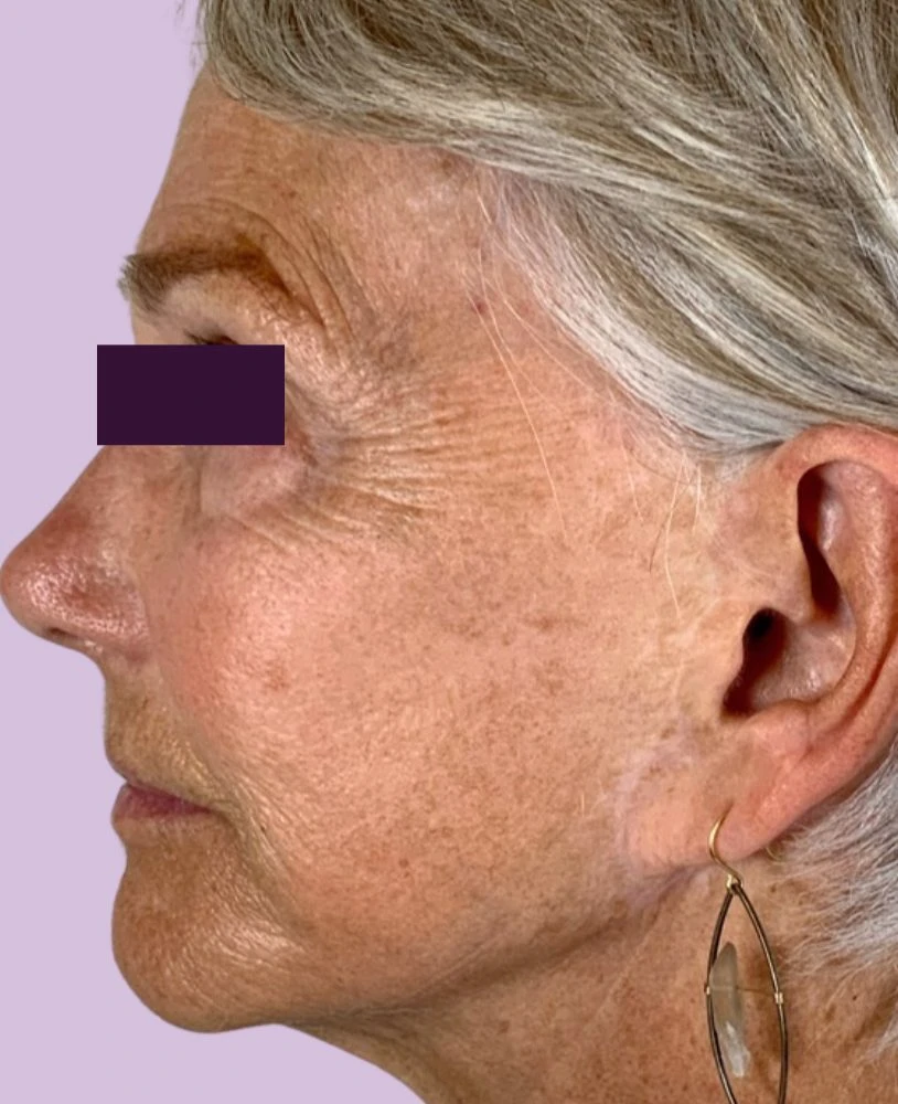 BBL /IPL Patient Photo - Case 6009 - before view-1