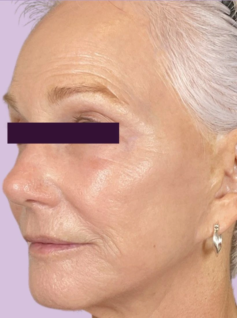 BBL /IPL Patient Photo - Case 6009 - after view