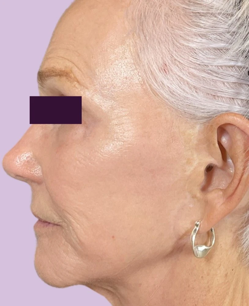 BBL /IPL Patient Photo - Case 6009 - after view-1