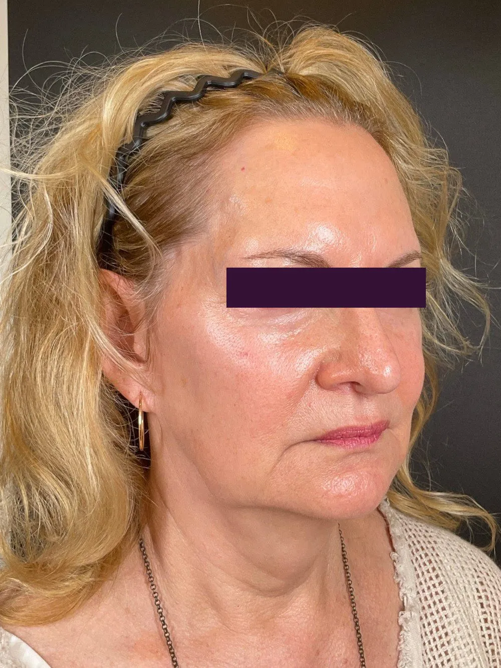Renuva Patient Photo - Case 6031 - after view