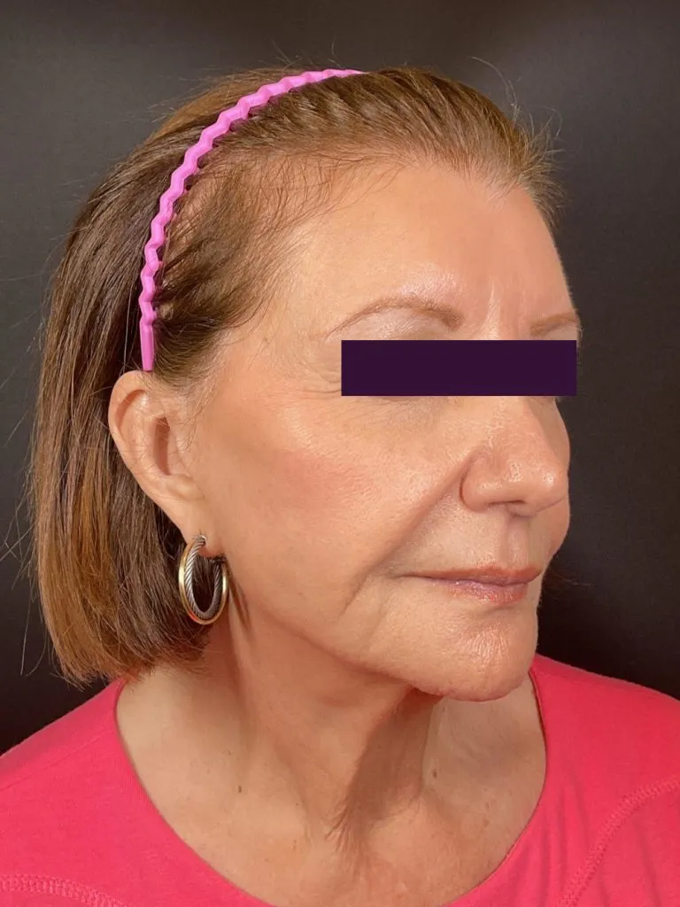 BOTOX® Cosmetic - Case 6035 - Before