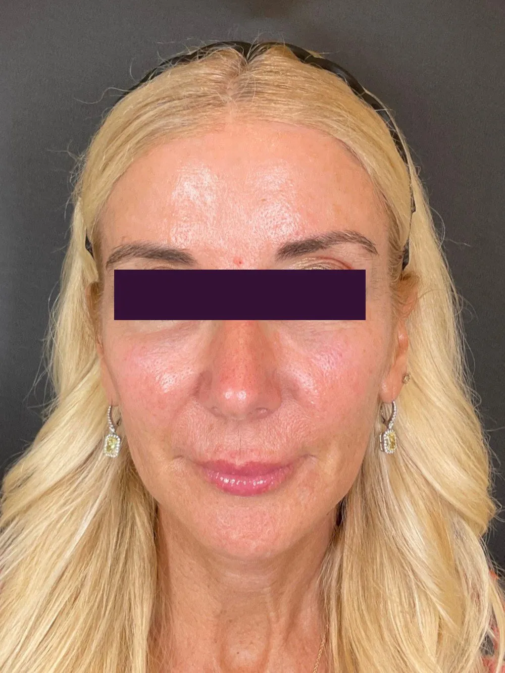 Renuva Patient Photo - Case 6039 - before view-