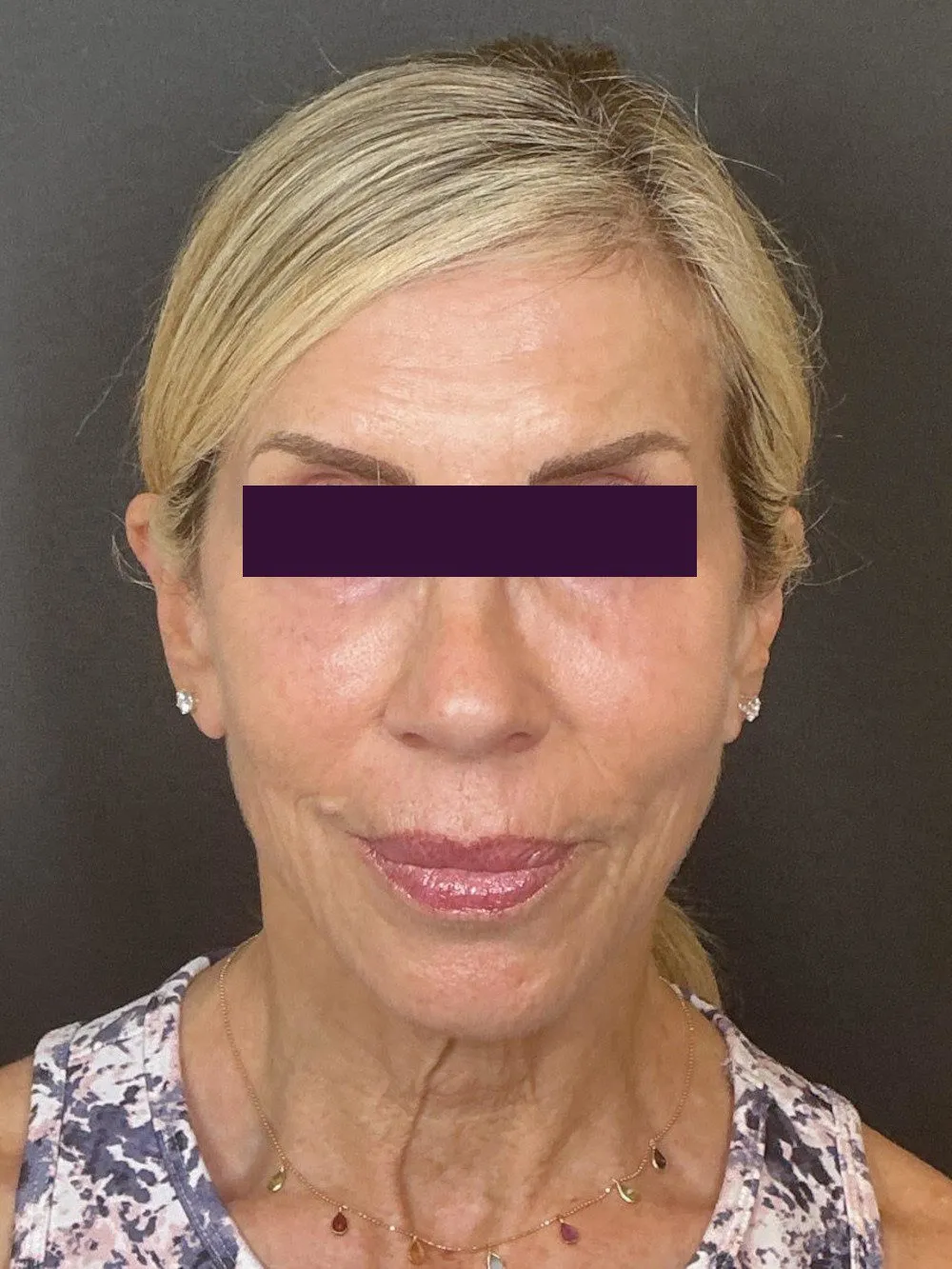 BBL /IPL Patient Photo - Case 6047 - before view-